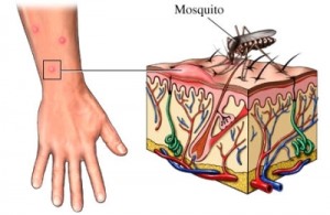 mosquito_bite