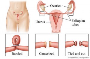 400px-Female_sterilization